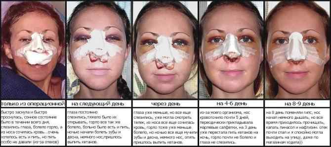 vidy-operacij-septoplastiki-nosovoj-peregorodki